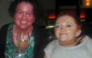 Carly Findlay and Stella Young
